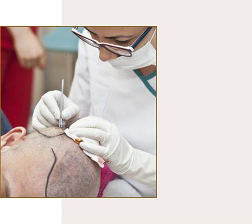 کاشت مو به روش Follicular Unit Extraction کاشت مو به روش Follicular Unit Extraction